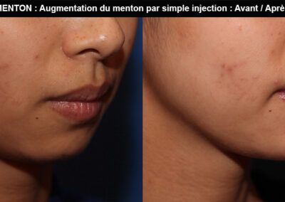 augmentation du menton par simple injection avant après