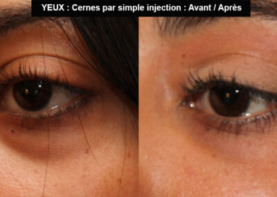 Injection pour réduire les cernes avant après