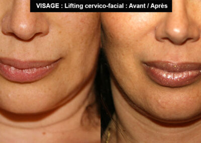 lifting cervico-facial avant après