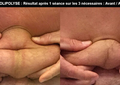 Cryolipolyse : Résultat après 1 séance sur les 3 nécessaires