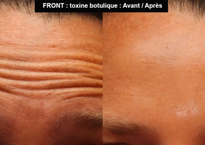 Injection front toxine botulique avant après