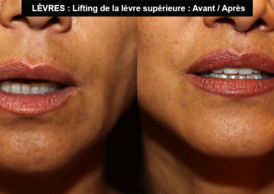 lifting de la lèvre supérieure à paris