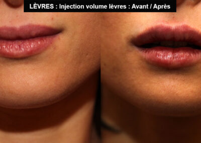injection lèvre avant après