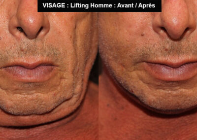 Lifting homme avant après