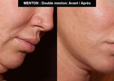 Chirurgie double menton avant après