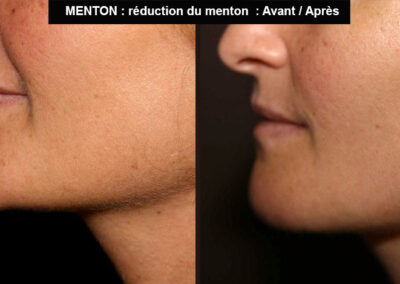 Chirurgie de réduction du menton avant après
