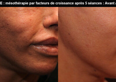 mésothérapie visage à paris