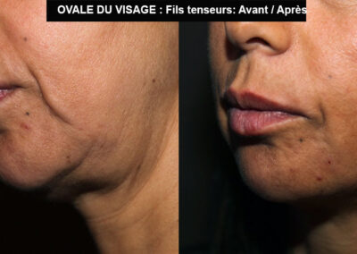 fils tenseur ovale du visage avant après