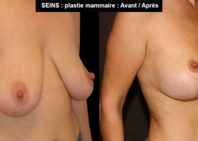 Ptose mammaire avant après