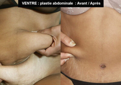 abdominoplastie résultat avant après