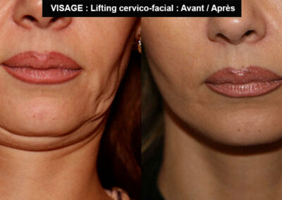 lifting cervico-facial avant après