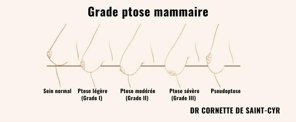 grade ptose mamamire mastopexie