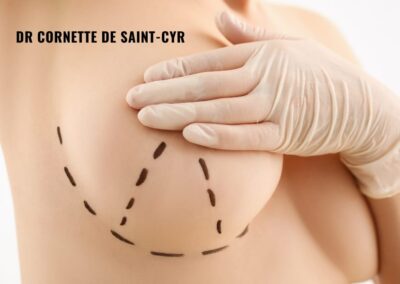 Ptose mammaire à Paris et mastopexie : grade, technqiue et remboursement