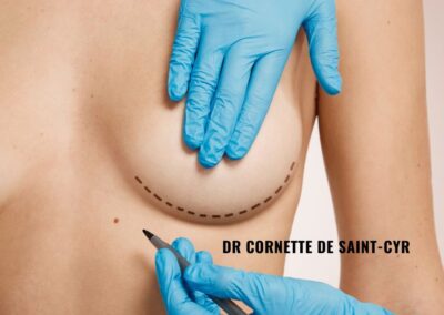 Augmentation mammaire par prothèse à Paris