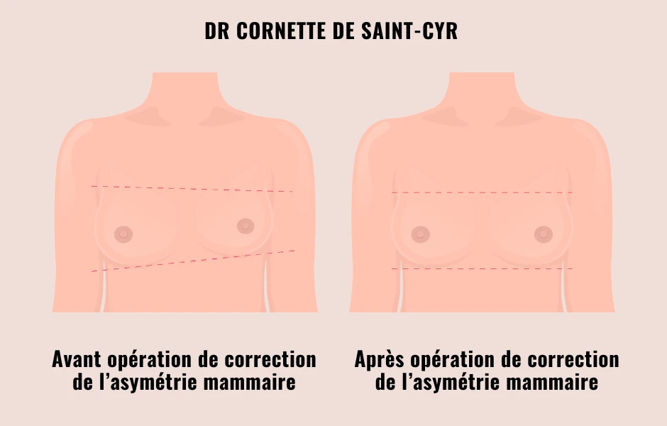correction sein plus gros que l'autre