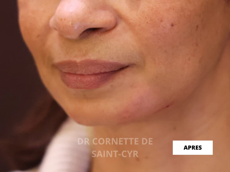 Après combinaison AH + Nefertiti