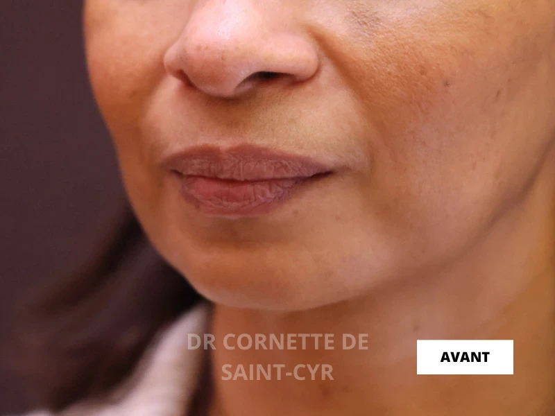 Avant combinaison AH + Nefertiti