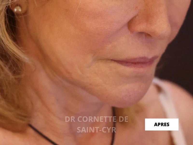 Après Nefertiti jawline