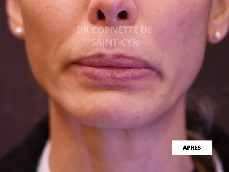 Après traitement Nefertiti