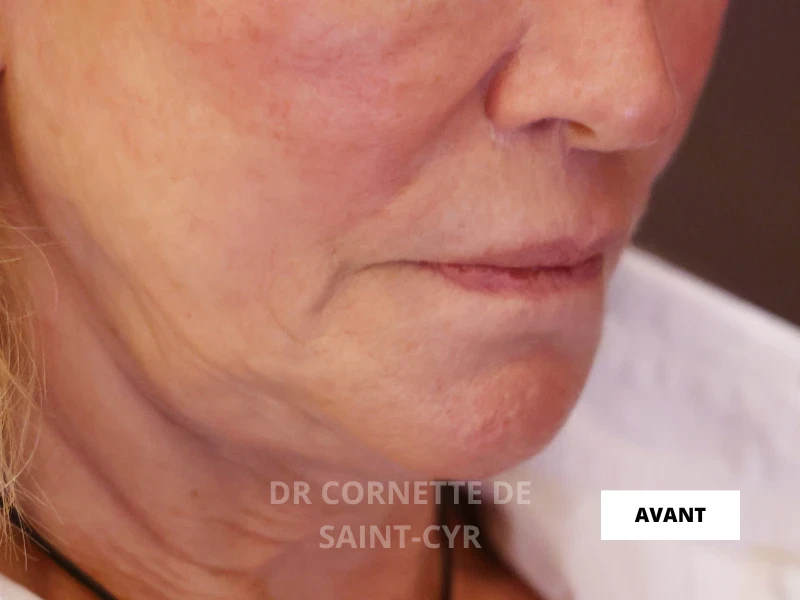 Avant traitement jawline
