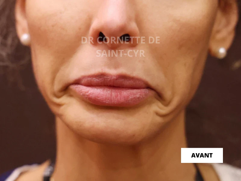 Avant traitement Nefertiti
